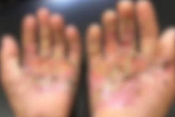 Conforme a Polícia Civil, as lesões do adolescente evoluíram para um quadro infeccioso grave, com risco de amputação
